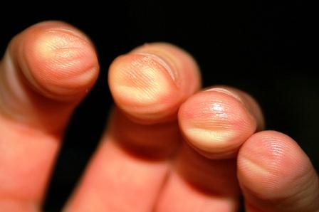 guitar-fingers-ouch